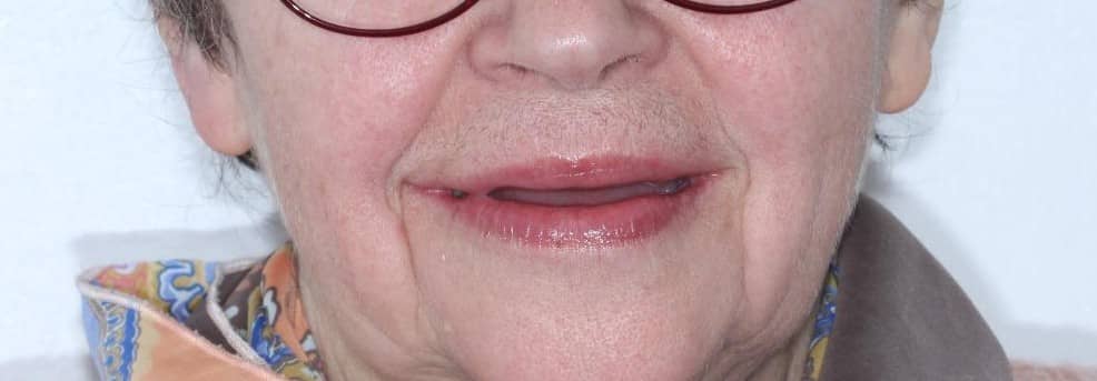 Full-arch rehabilitation case 1 before