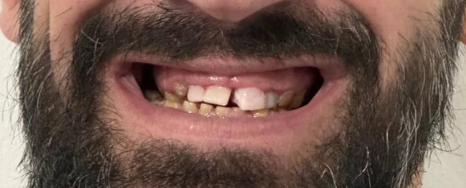 Full-arch rehabilitation case 2 before