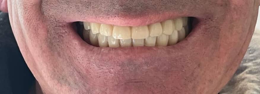 Full-arch rehabilitation case 3 after