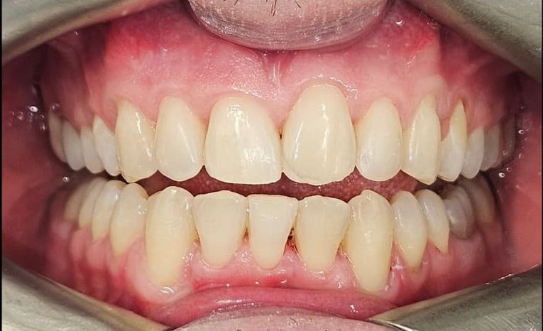 Smile makeover 2 - after