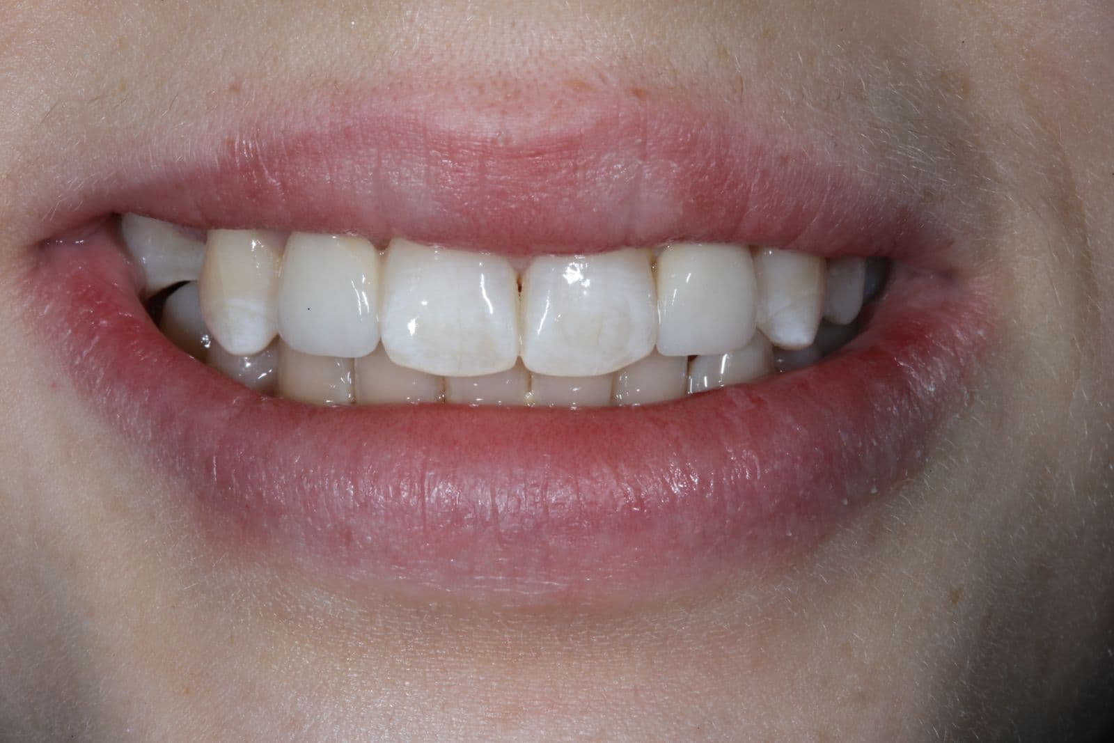 Smile makeover 3 - after