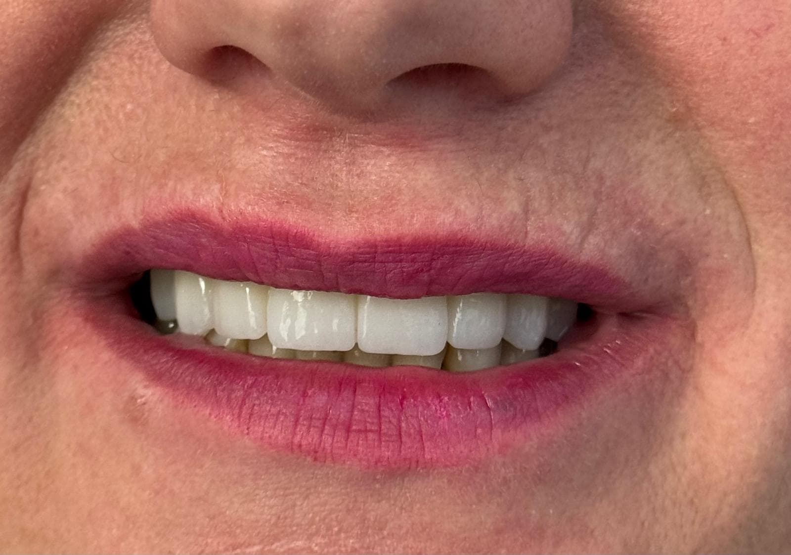 Smile makeover 4 - after