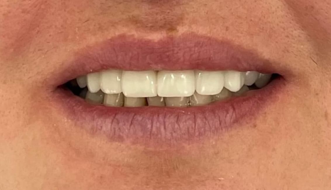 Smile makeover 5 - after