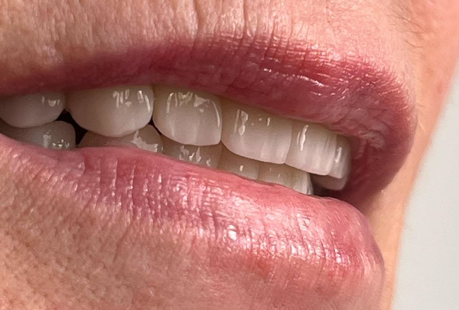 Smile makeover 6 - after