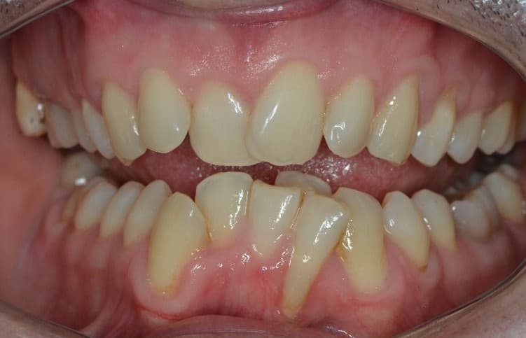 Smile makeover 2 - before