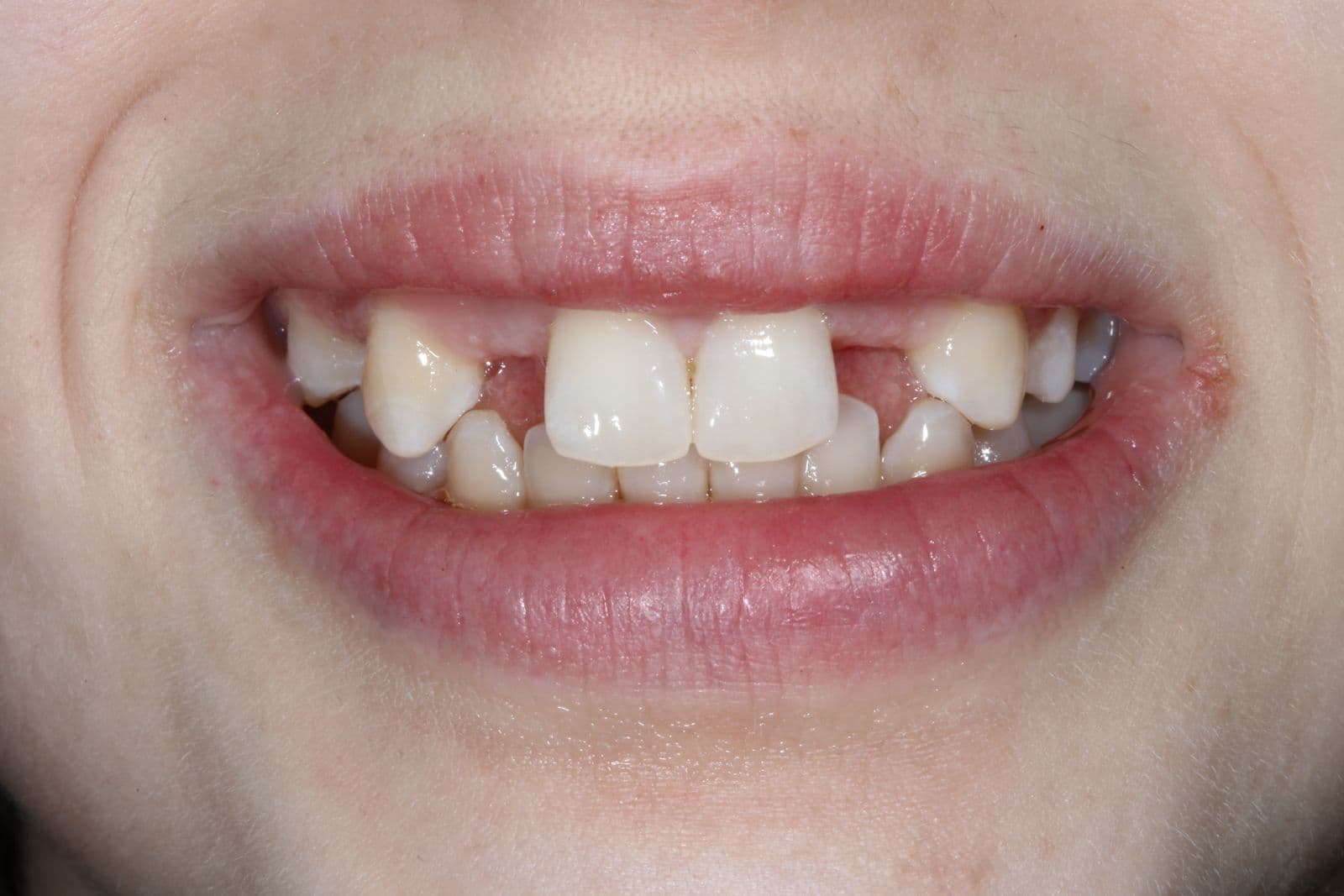 Smile makeover 3 - before