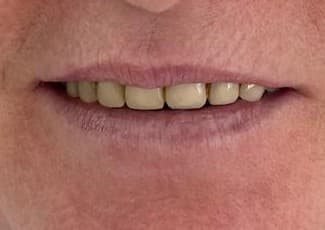 Smile makeover 4 - before