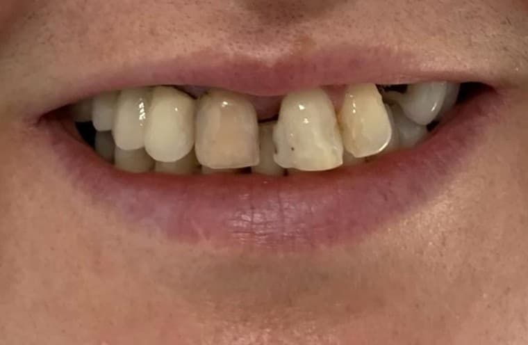 Smile makeover 5 - before
