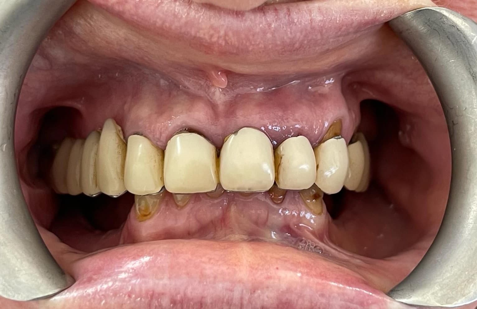 Smile makeover 6 - before