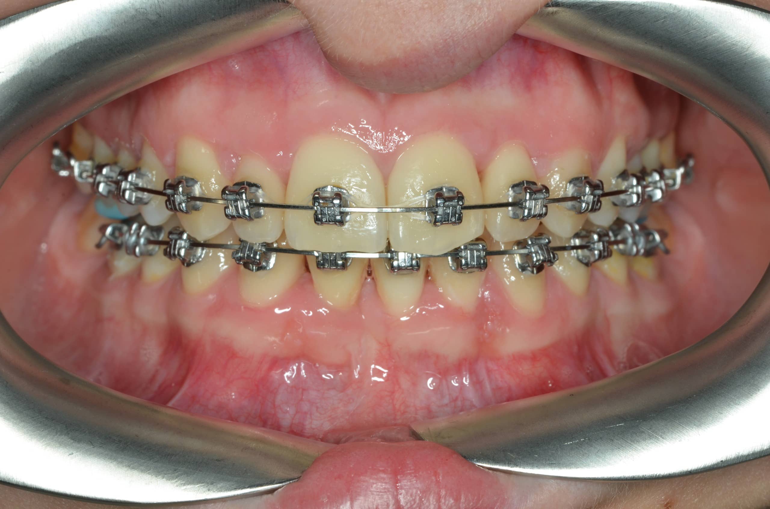Orthodontic case 1 after