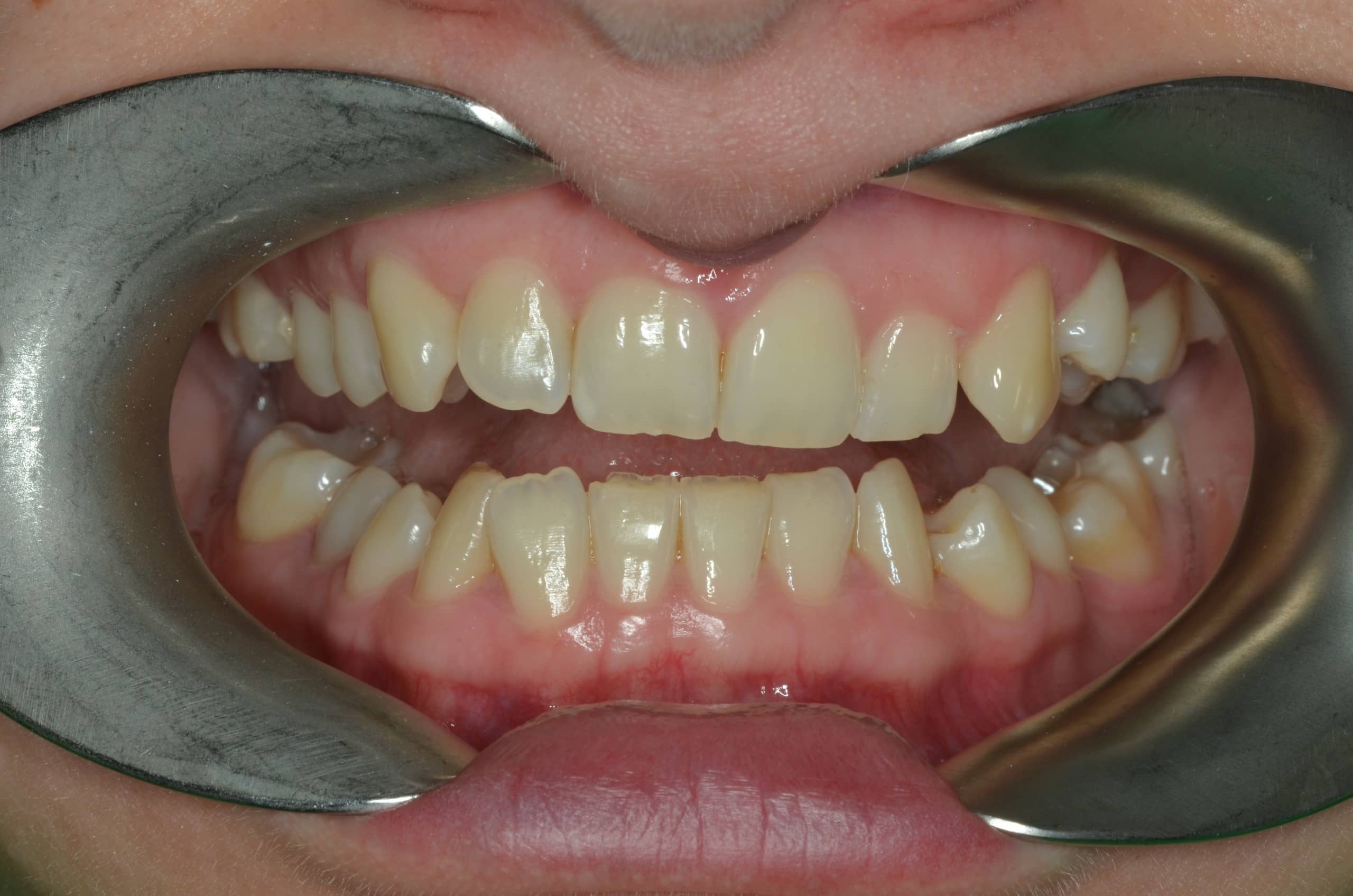 Orthodontic case 3 before
